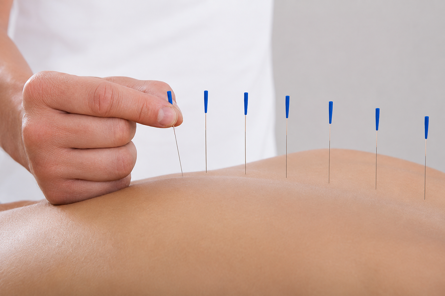 acupuncture - Restorative Natural Medicine