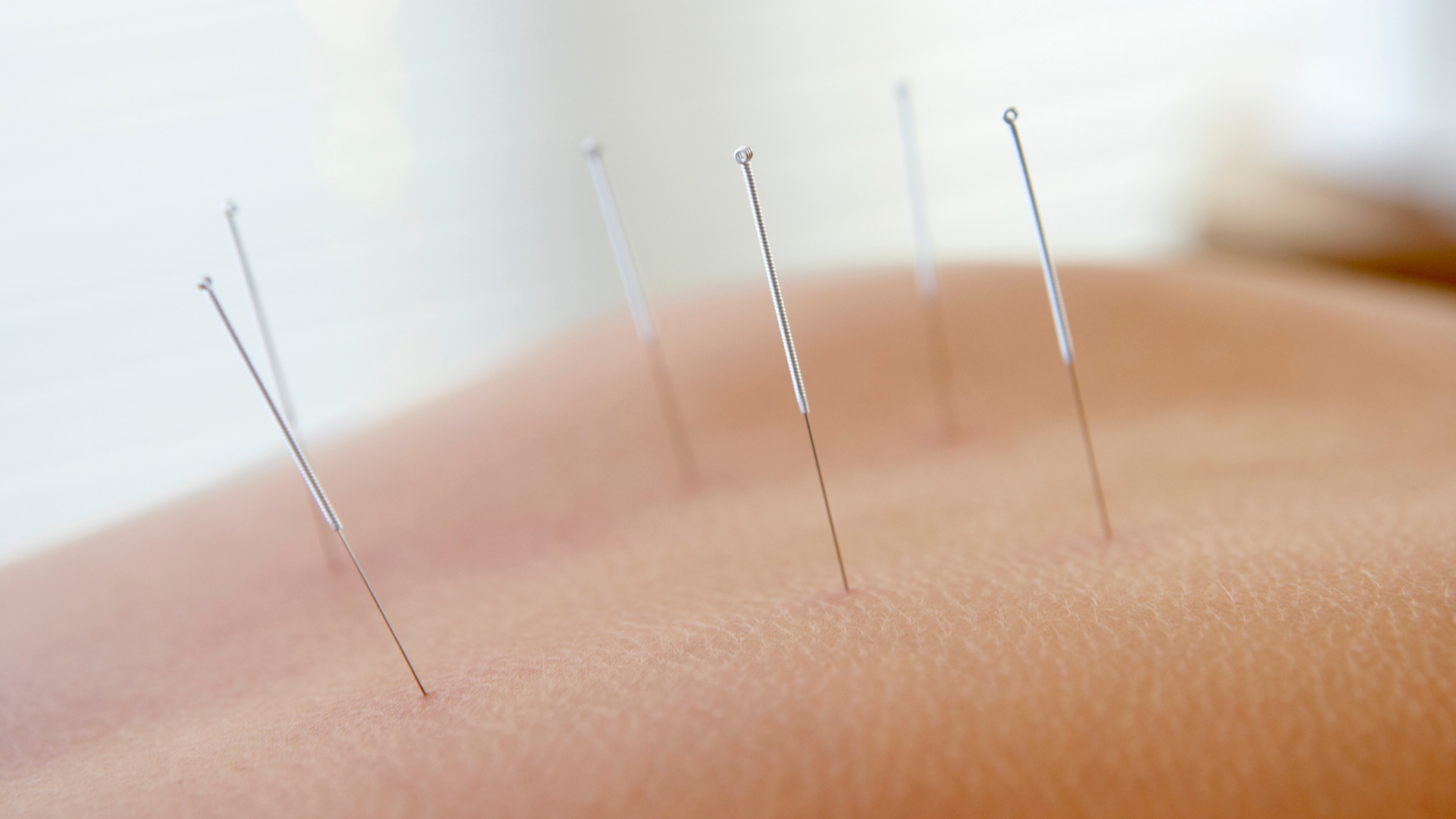 acupuncture in Bellevue WA