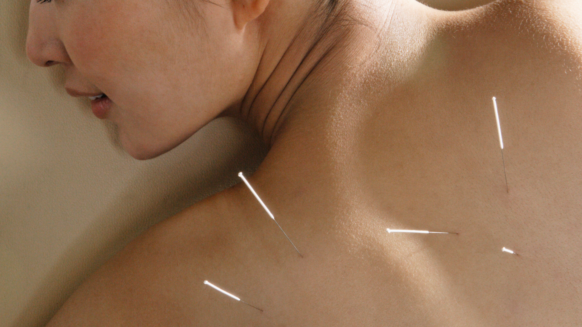acupuncture near me 1